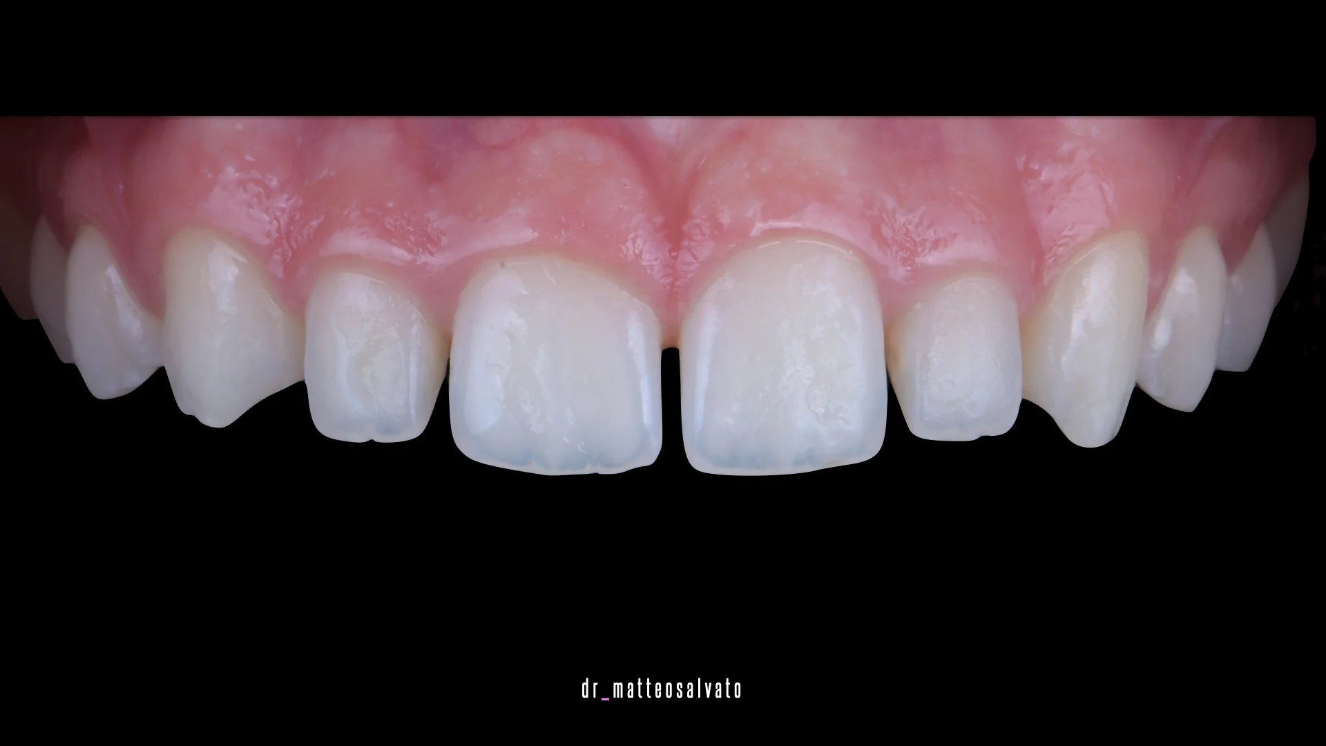 Conservativa adulti prima Conservativa adulti prima