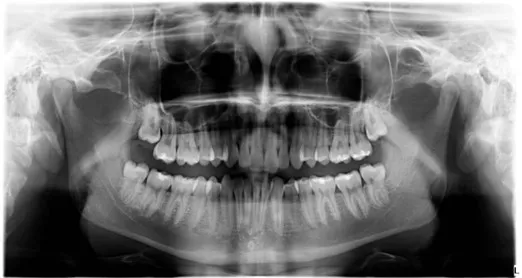 Estrazione denti del giudizio