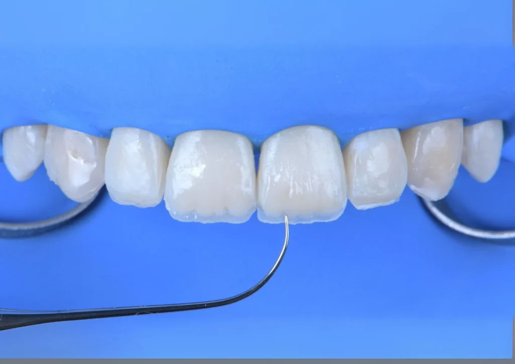 Faccette dentali - studio dentistico dutto