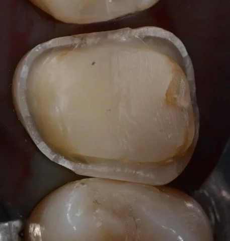 INTARSIO DENTALE PRIMa INTARSIO DENTALE PRIMa