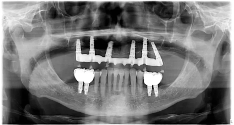 all on four six implantologia guidata prima e dopo