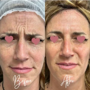 botox prima e dopo