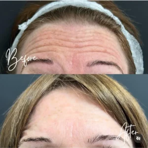 botox prima e dopo