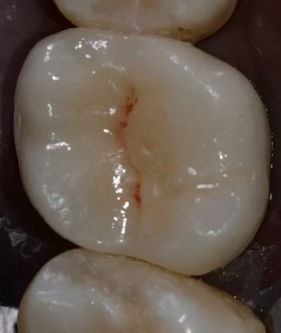 intarsio dentale DOPO