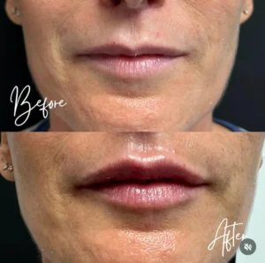 lips prima e dopo