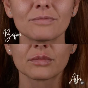 lips prima e dopo (2)