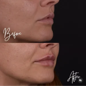 lips prima e dopo 3