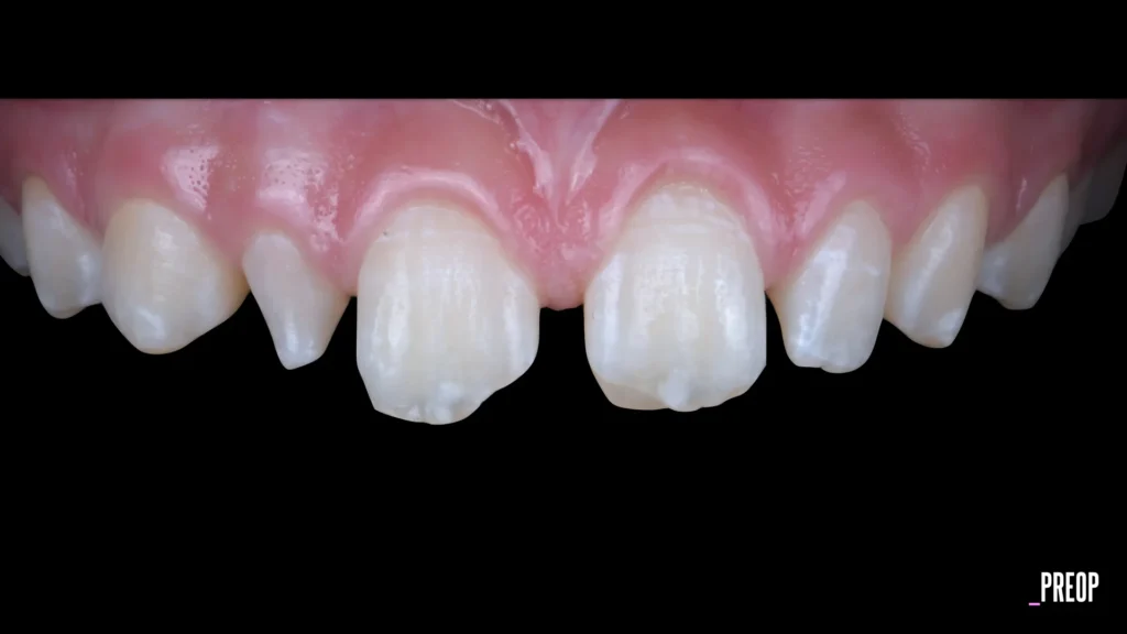 Conservativa - step 2