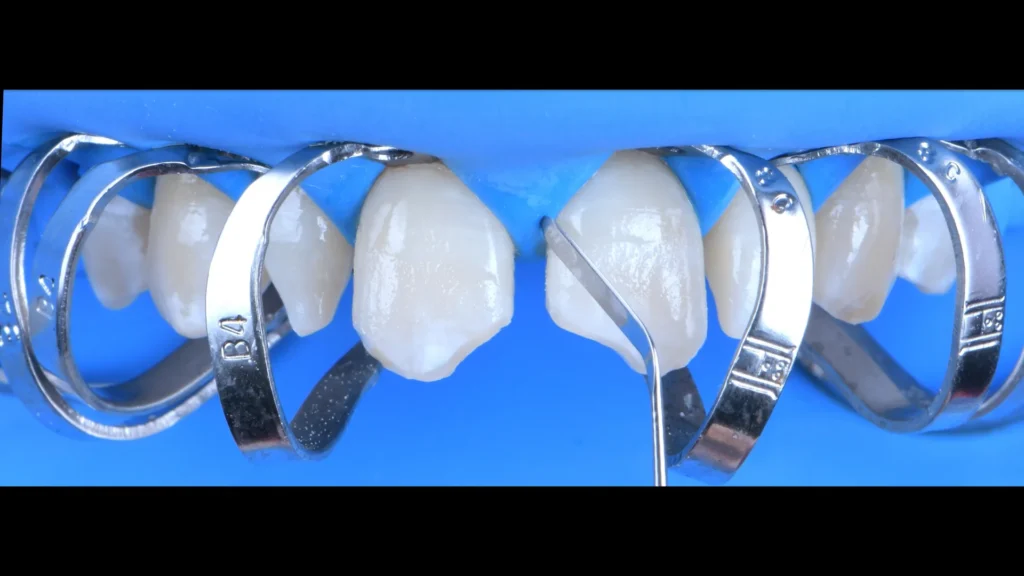 Conservativa - step 6